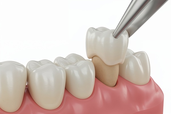 How Long Should My New Dental Crown Last?