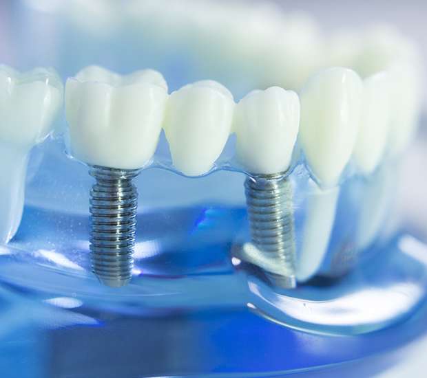 Jasper Dental Implants